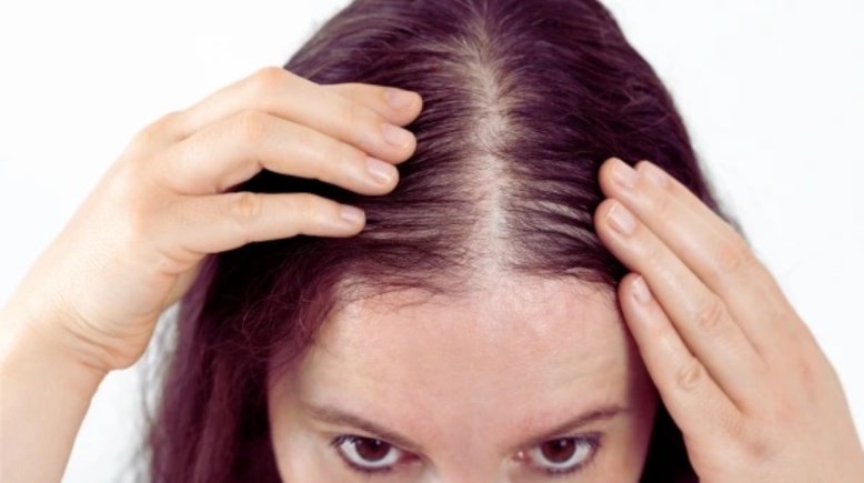 تساقط الشعر