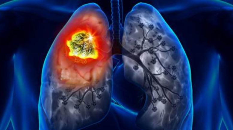 سرطان الرئة 