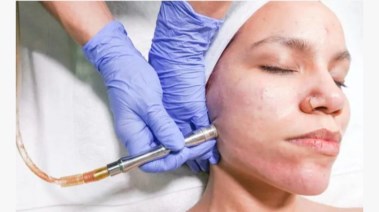 علاج حب الشباب 