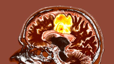 الورم الأرومي 