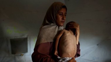 سوء التغذية في غزة 