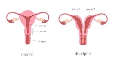 الفرق بين الرحم الطبيعي والمزدوج