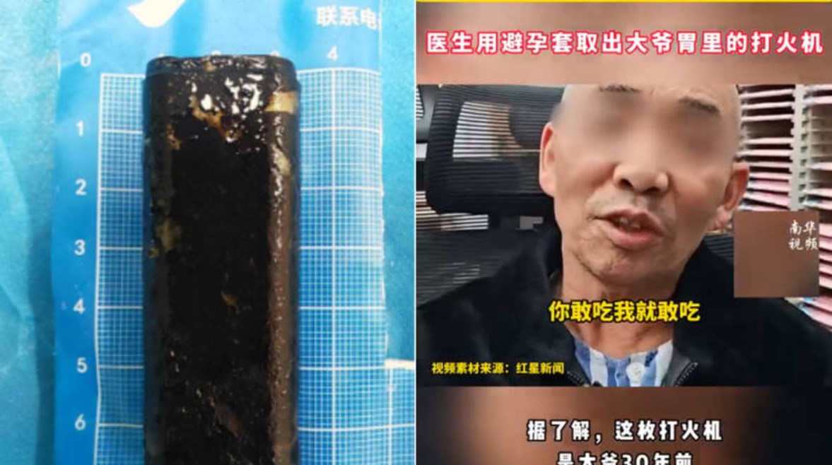 الرجل الصيني والولاعة التي استخرجوها من معدته