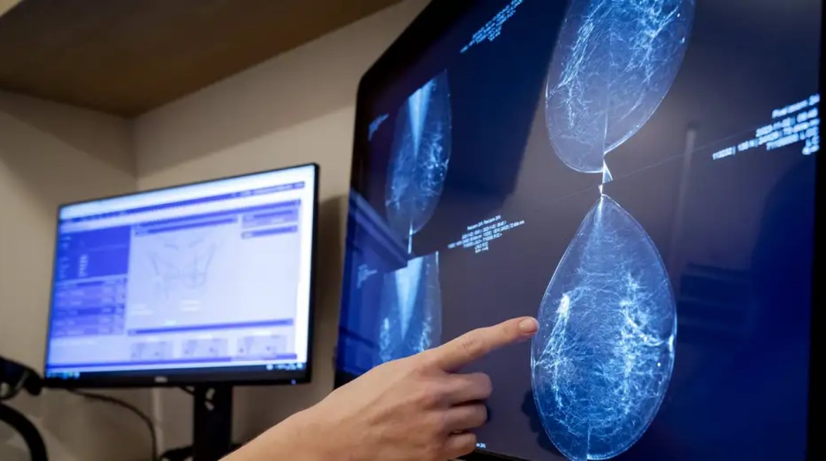 التصوير الإشعاعي لسرطان الثدي