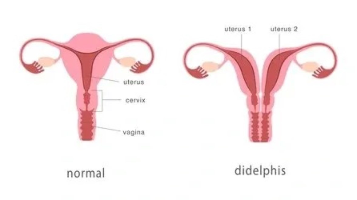 الفرق بين الرحم الطبيعي والمزدوج