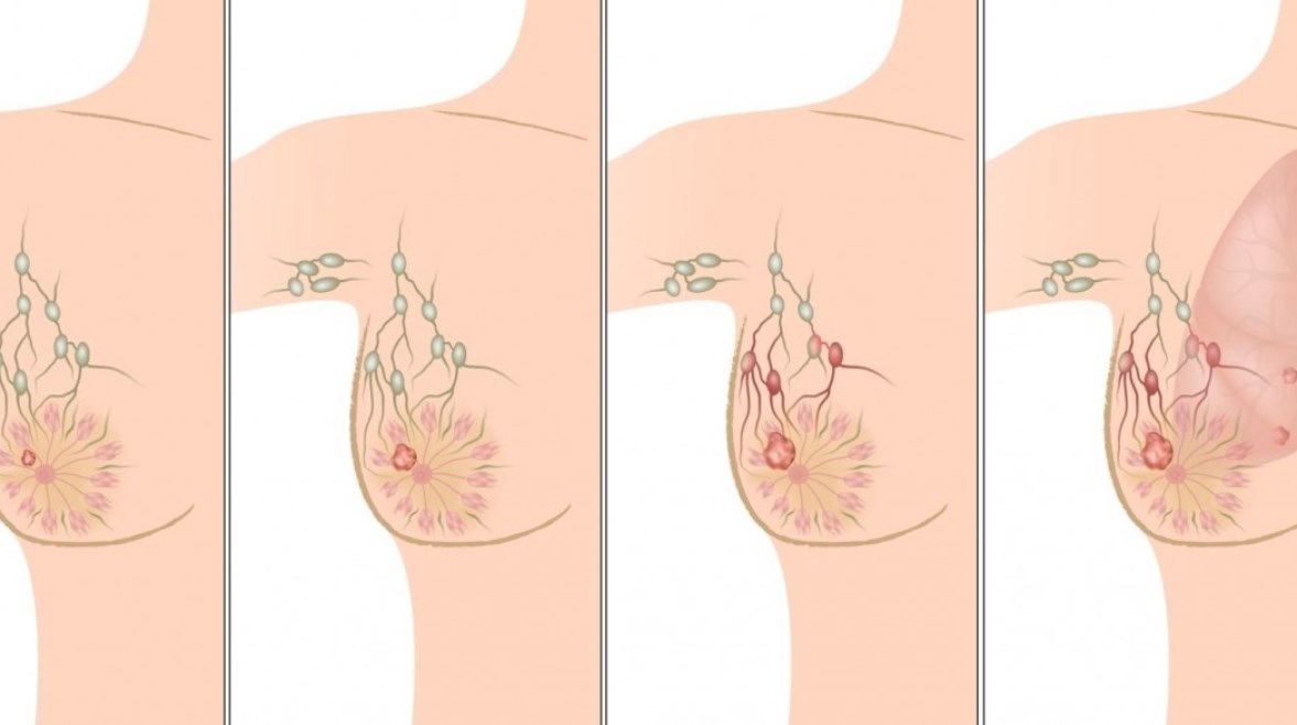 5 أعراض.. كيف تعرفين أنكِ مصابة بسرطان الثدي؟
