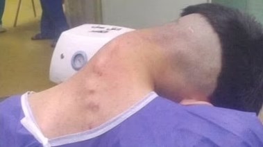 متلازمة الرأس الساقطة