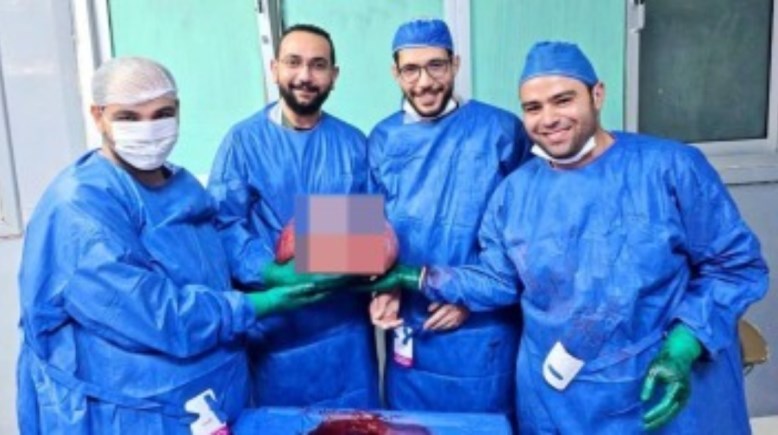 الفريق الطبي بعد استئصال الورم