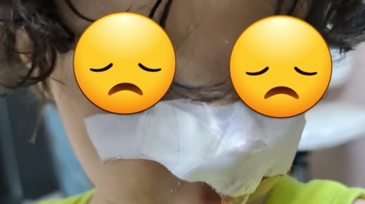 الطفل ميخا بعد تعرضه لاعتداء كلب ضال الطفل ميخا بعد تعرضه لاعتداء كلب ضال