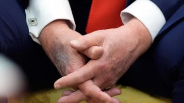 كدمات ترامب تثير الجدل