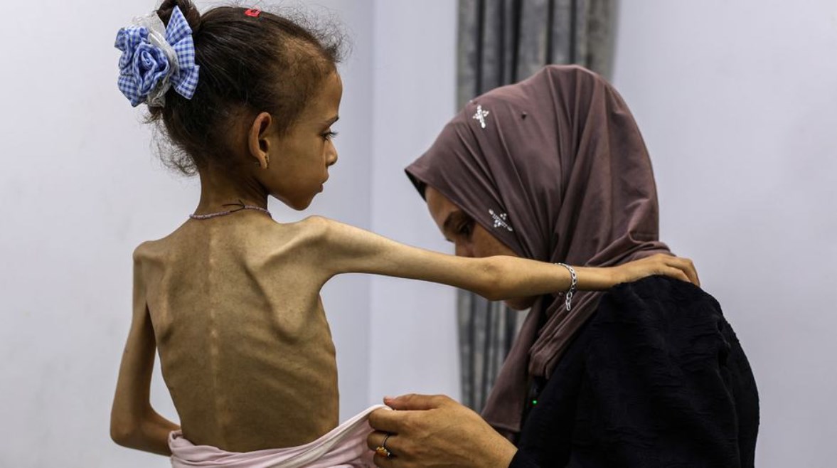 سوء التغذية في غزة سوء التغذية في غزة