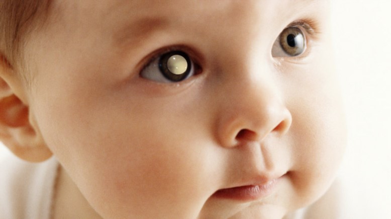 تحول بؤبؤ العين للون الأبيض