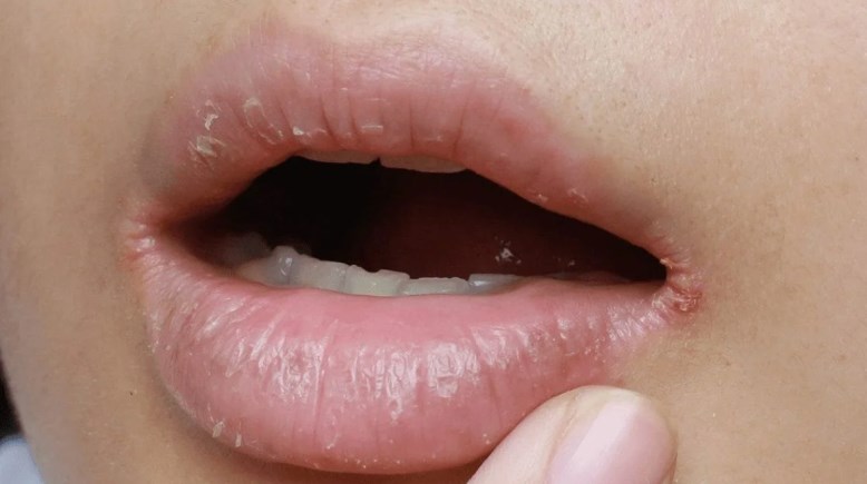 الإصابة بالتهاب الشفاه الفطري