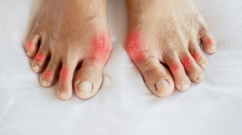 التهاب الروماتويدي