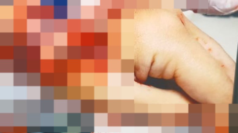 جانب من الإصابة