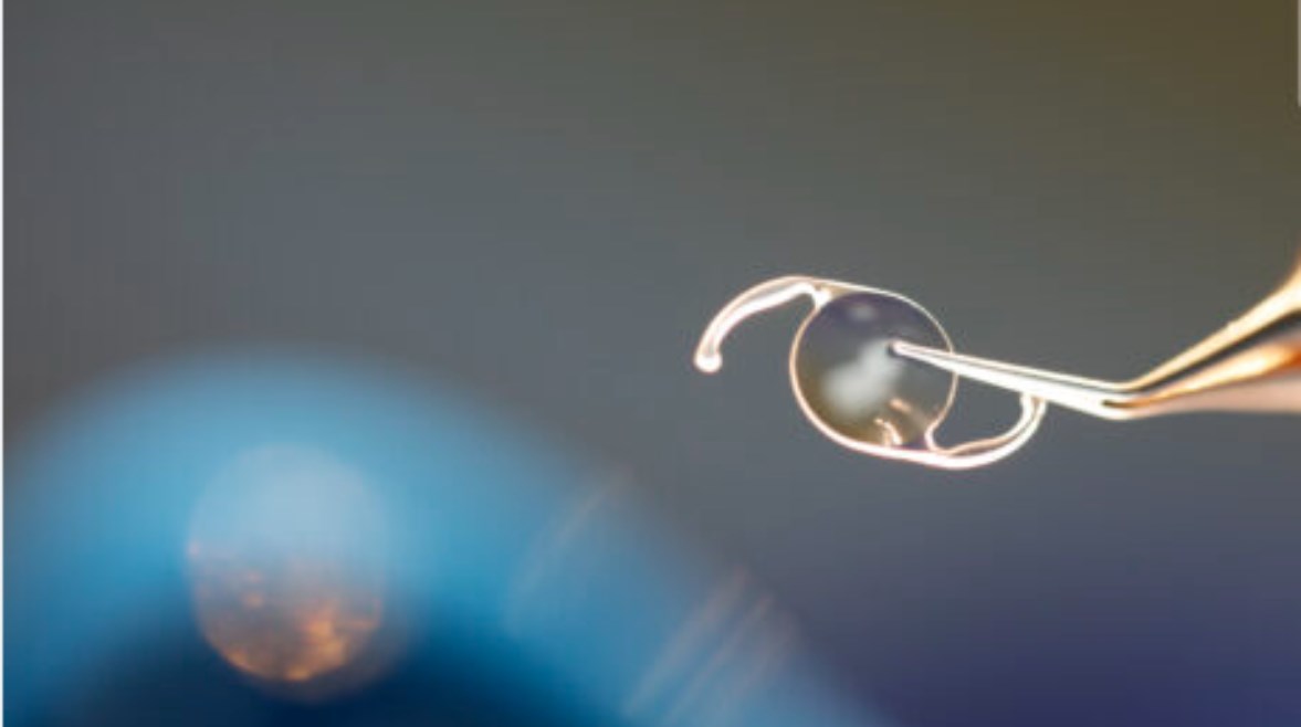 عملية زرع عدسة