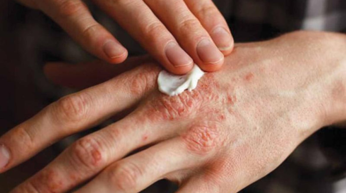 إكزيما الشتاء