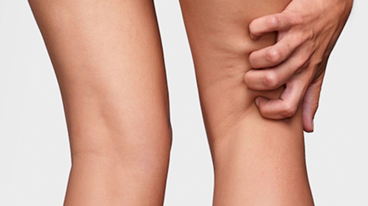 حكة الساقين