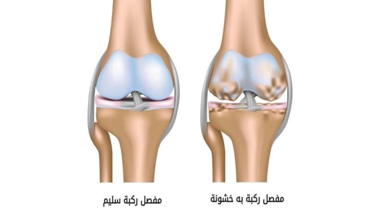 تعبيرية عن الركبة
