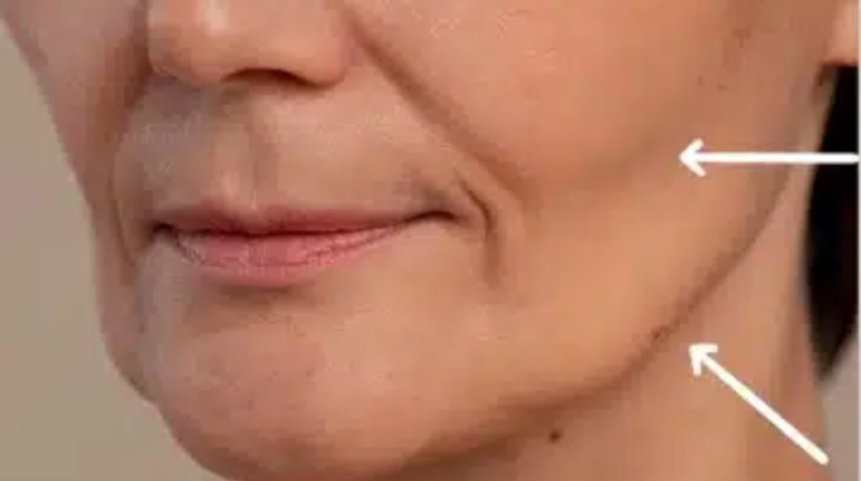 وجه أوزمبيك