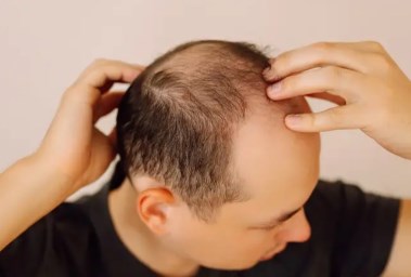 الصلع - صورة أرشيفية