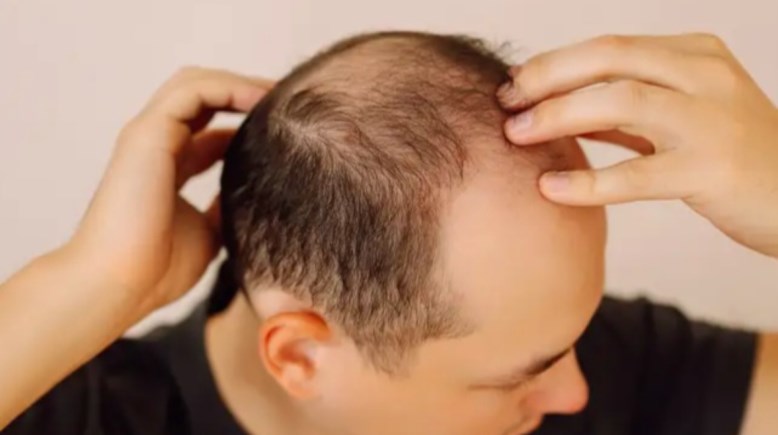 الصلع - صورة أرشيفية