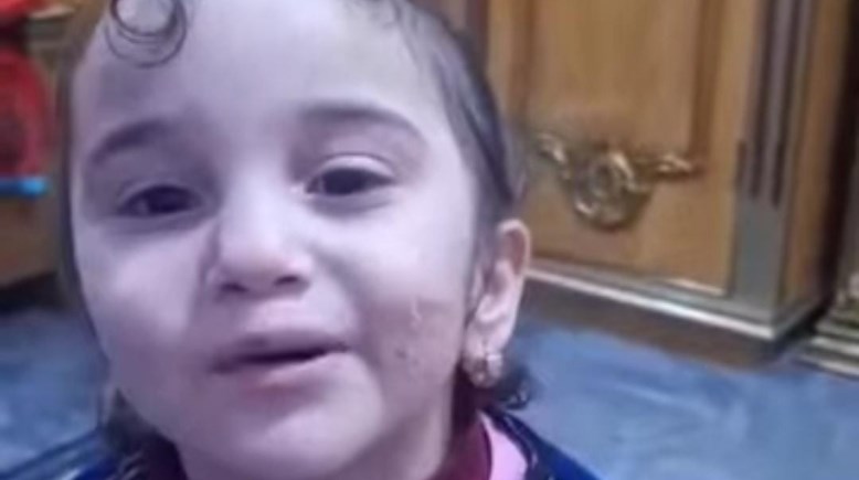 الطفلة وآثار التعذيب على وجهها