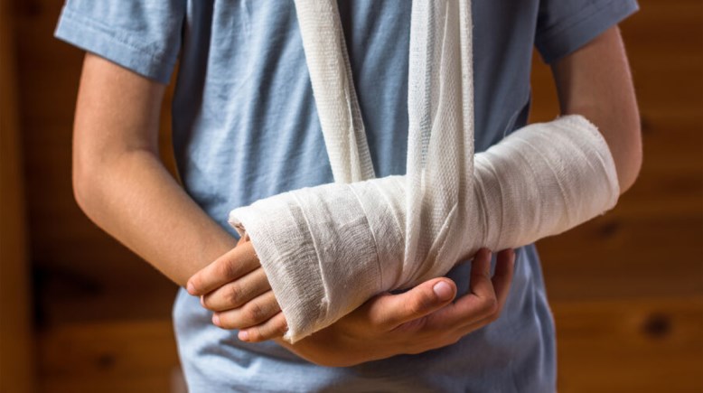 مسامير قابلة للتحلل لعلاج الكسور- تعبيرية