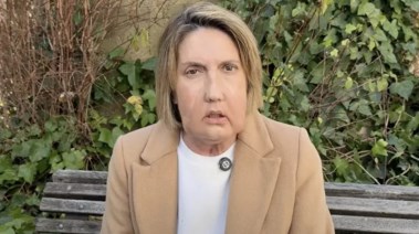 كارمي بعد زراعة الوجه