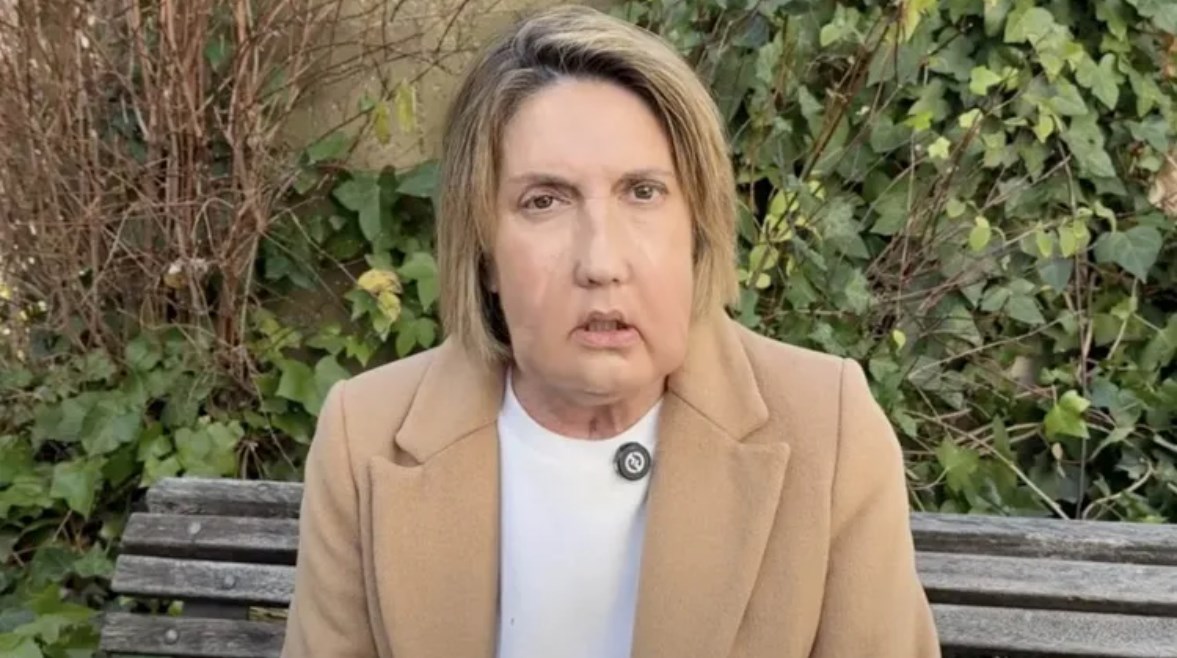 كارمي بعد زراعة الوجه