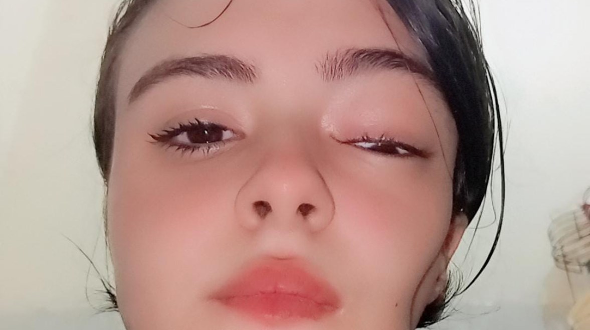 حبيبة قبل تدهور عينها