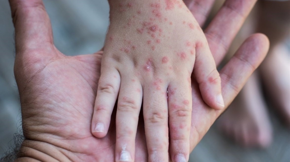 انتشار الحصبة في المكسيك