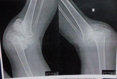 أشعة على ركبتي دعاء توضح التآكل