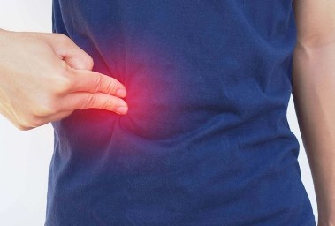 الفتق الإربي تعبيرية