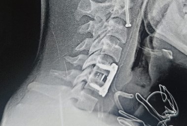 أشعة أجريب للمريض