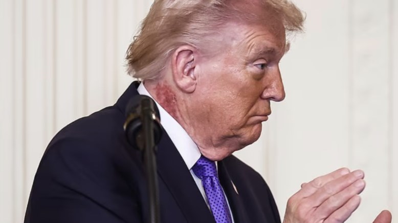 بقعة حمراء على رقبة ترامب