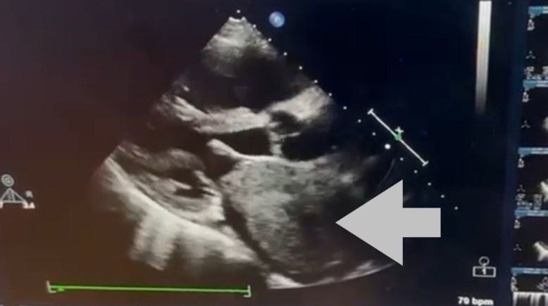 استئصال ورم ضخم