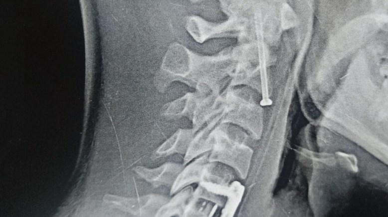 أشعة أجريب للمريض