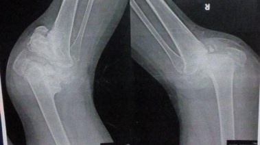 أشعة على ركبتي دعاء توضح التآكل