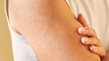 جلد الوزة- تعبيرية