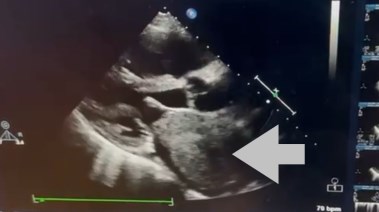 استئصال ورم ضخم