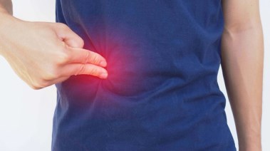 الفتق الإربي تعبيرية