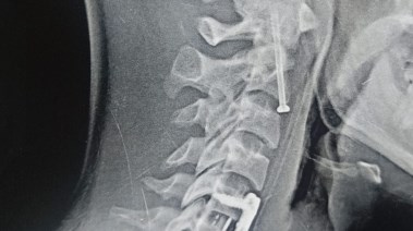 أشعة أجريب للمريض