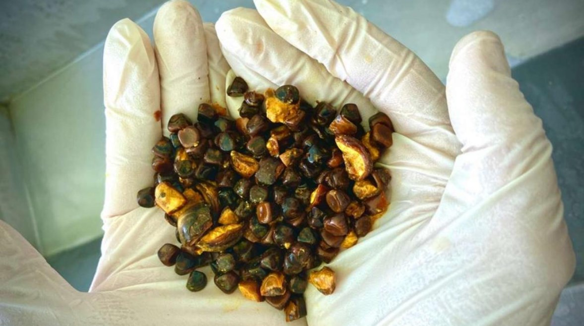 حصى المرارة البقرية