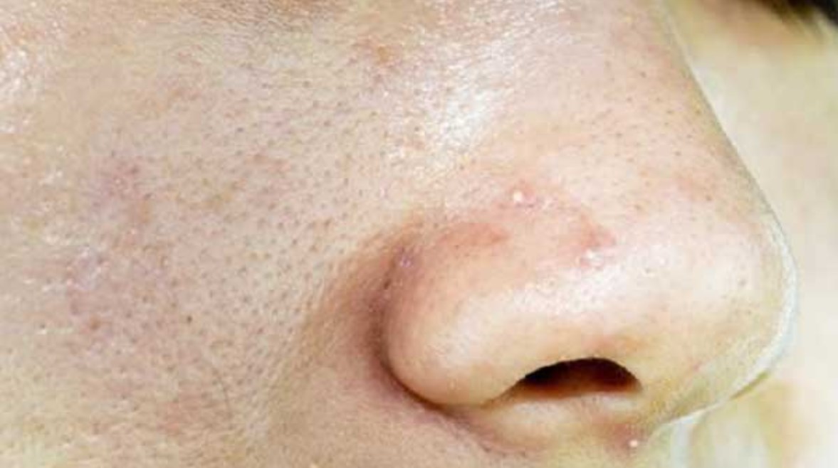 جفاف وتقشر الأنف