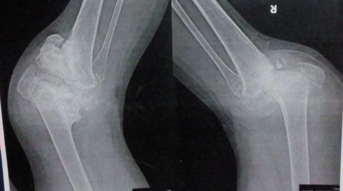 أشعة على ركبتي دعاء توضح التآكل