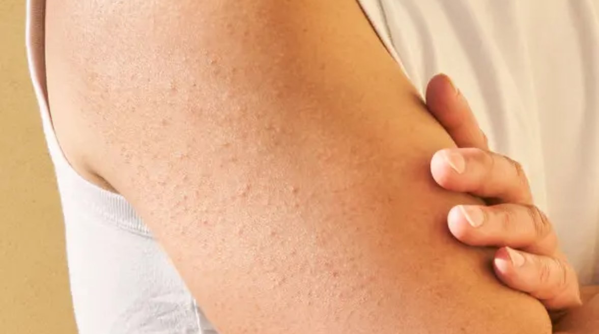 جلد الوزة- تعبيرية