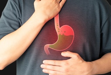 ارتجاع المريء