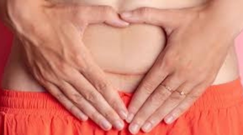 الولادة القيصرية