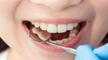 علاج تسوس الأسنان